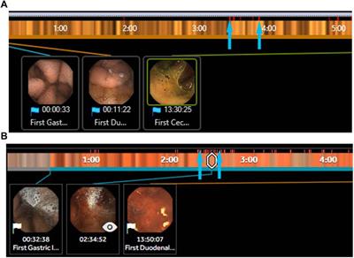 Endoscopic capsule robot-based diagnosis, navigation and localization in the gastrointestinal tract